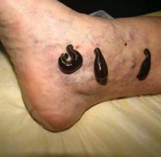 Photo of leeches on a patient's ankle